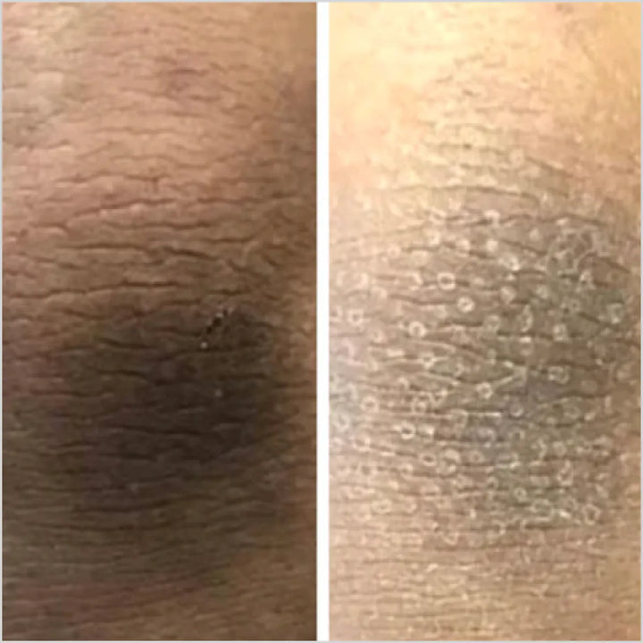 BSK204 CLEARING TONE skin lightening kit for intimate and sensitive areas before after - Skinae.pk