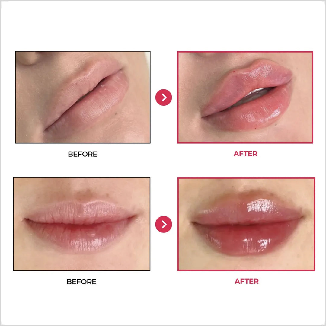 Tesoro Rouge - Best Lip Filler in Pakistan - Made in Korea - Before and After - Skinae