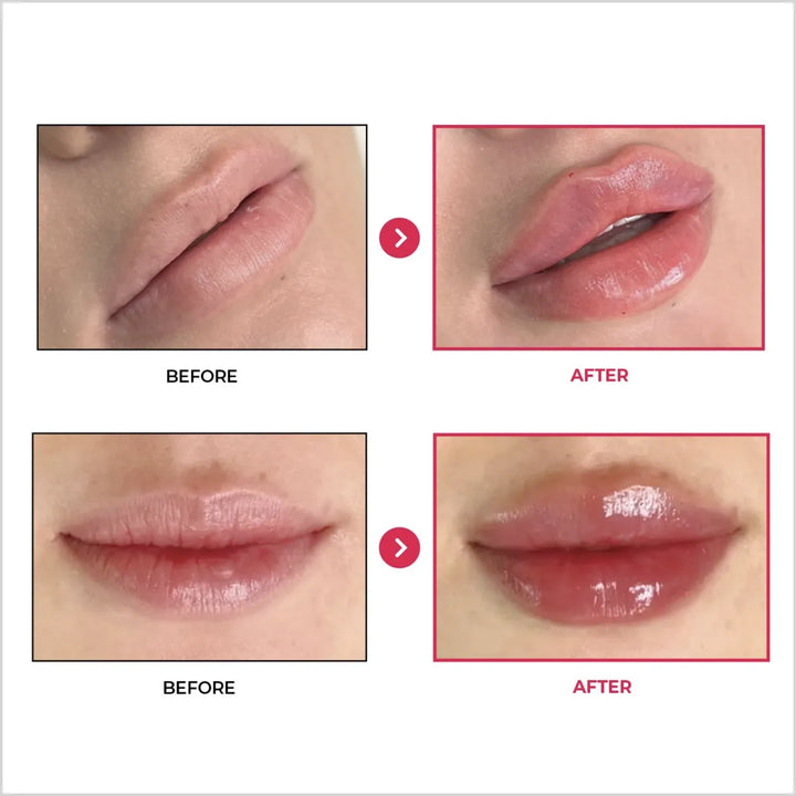 Tesoro Rouge - Best Lip Filler in Pakistan - Made in Korea - Before and After - Skinae