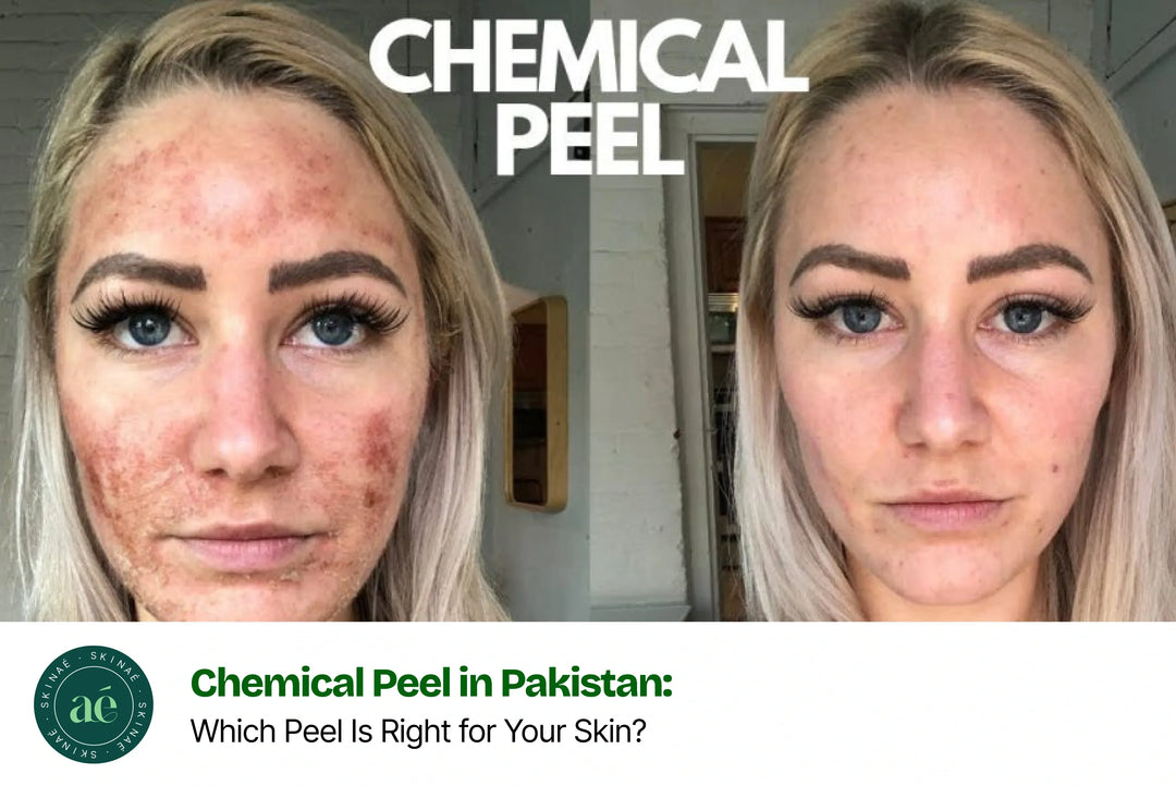 Chemical Peel in Pakistan showing different peel types for acne scars, pigmentation, wrinkles and glowing skin available at Skinae.pk