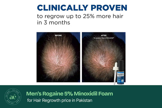 Men’s Rogaine 5% Minoxidil Foam for Hair Regrowth Price in Pakistan