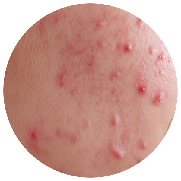 Acne & Breakouts