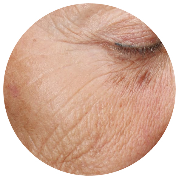 Wrinkles & Aging
