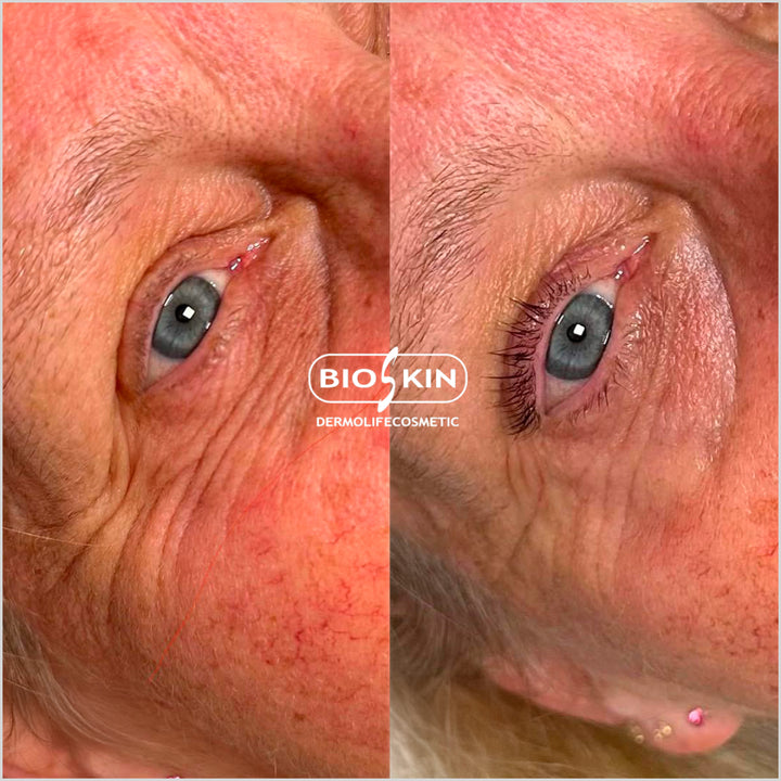 Bioskin - Eye pro contour before and after picture