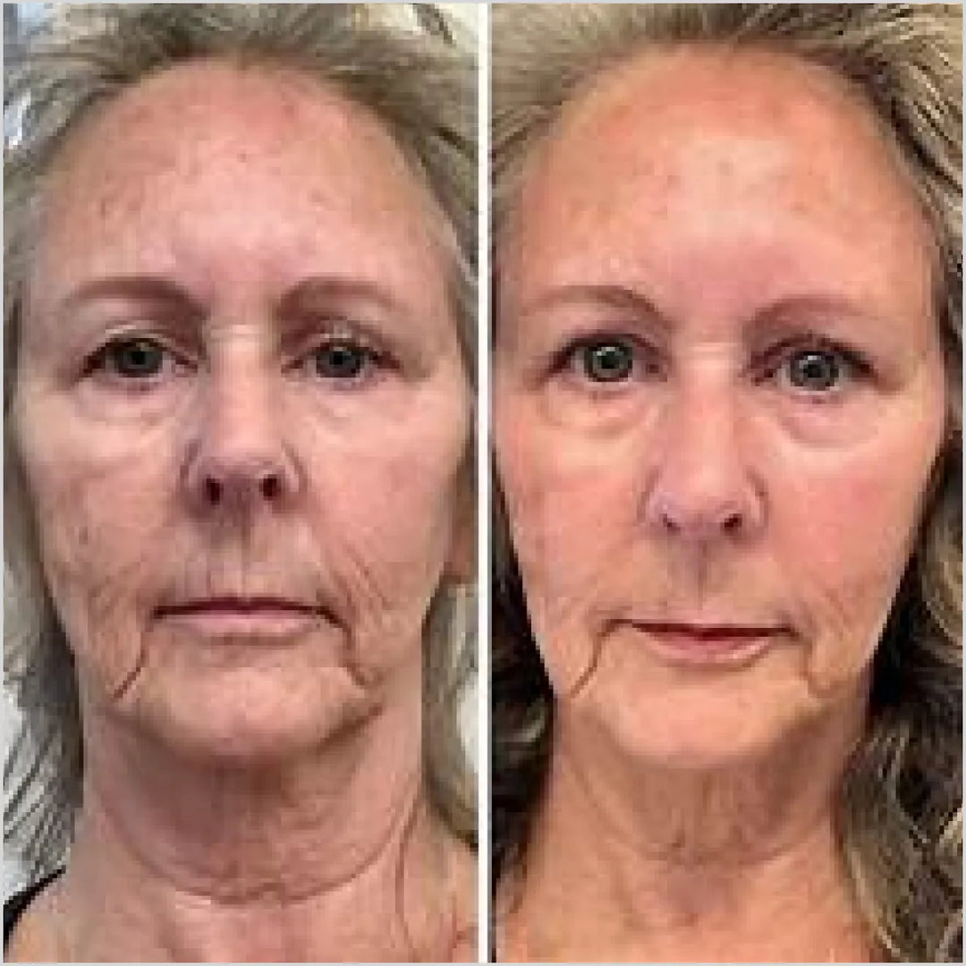 BSK36 COLLAGEN-HA PRO solution before and after.