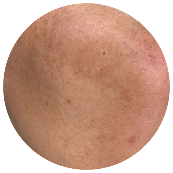 Dull & Dry Skin