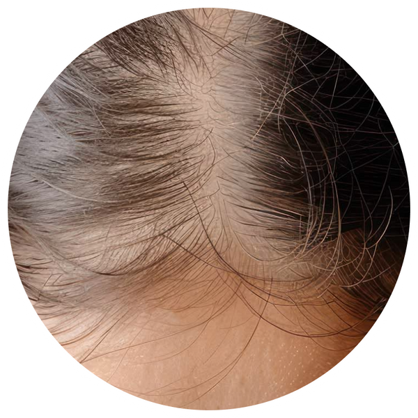 Hair Loss