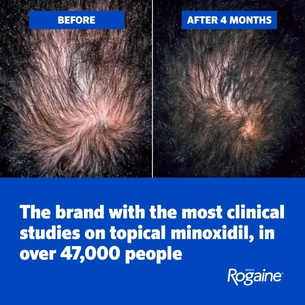 Before and after comparison of hair thickness with Rogaine branding.
