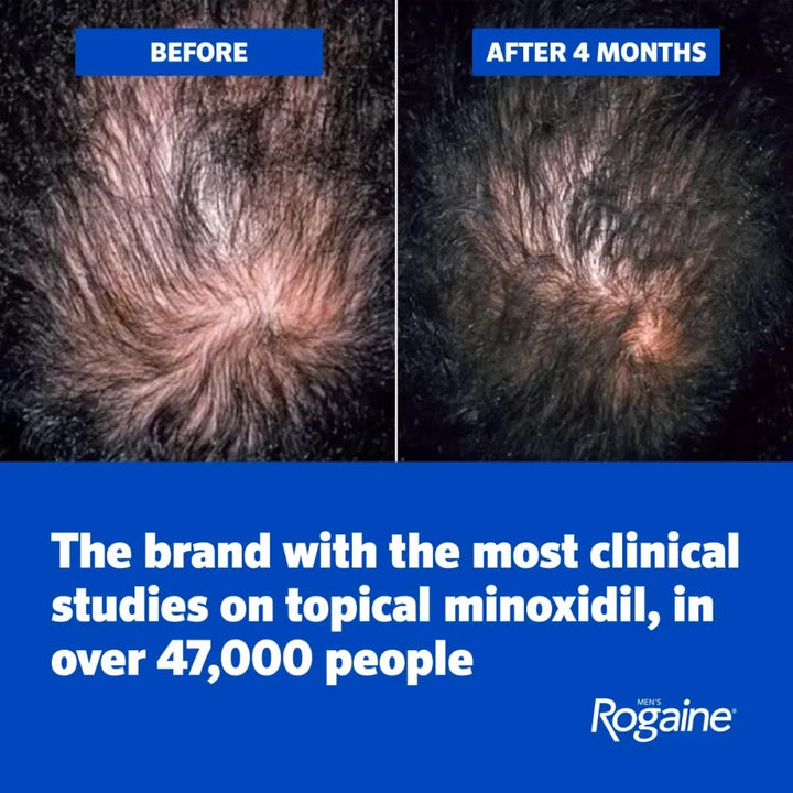 Before and after comparison of hair thickness with Rogaine branding.