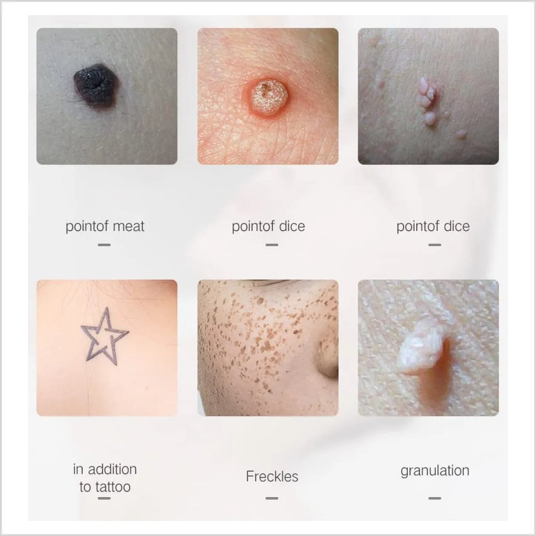 Mole Remover Pen - Uses - Skinae