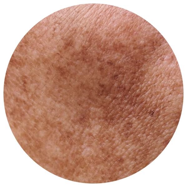 Pigmentation & Melasma