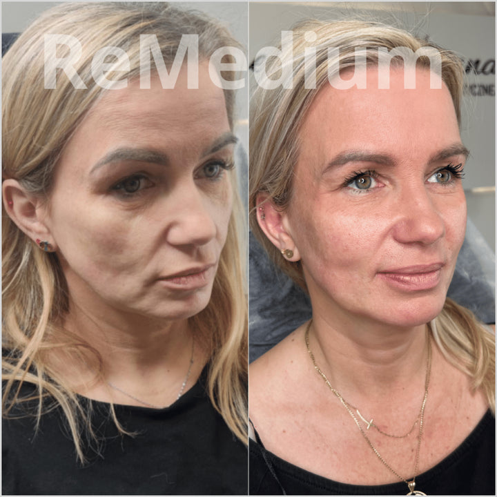 ReMedium PDRN skin therapy injection for collagen repair – Skinae